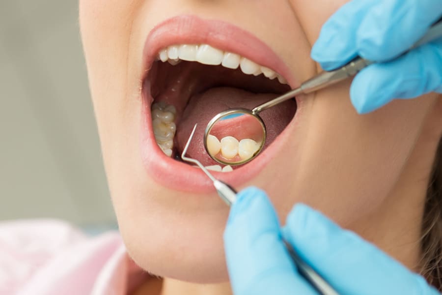 Клиновидный дефект зубов отбеливание зубов стерилизатор зубных щеток купить спб