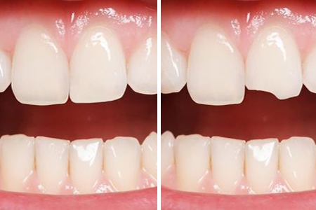 Как проходит наращивание зуба