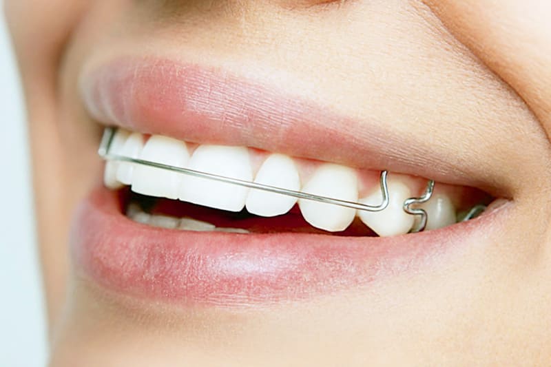 Пластинки для выравнивания зубов Томск Измайловский стоматология томск здоровье на кирова