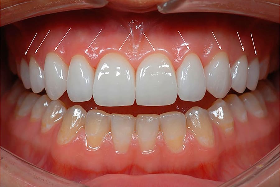 Изменение формы зубов